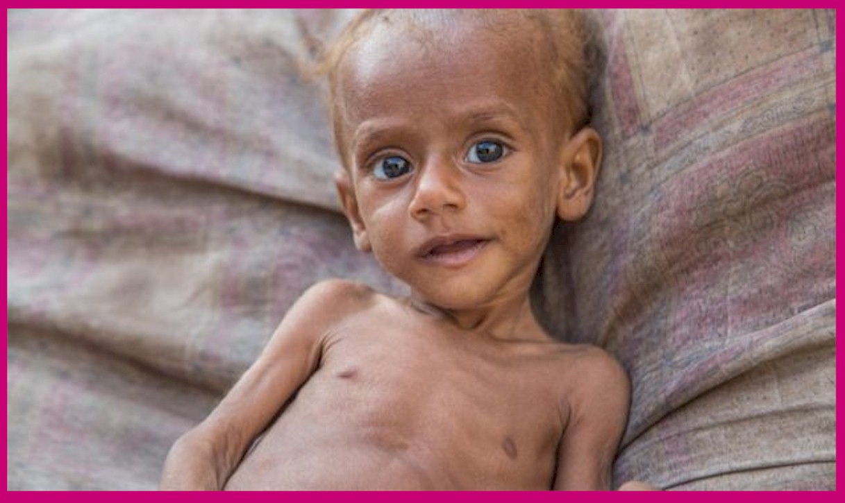 Severe malnutrition in Yemen